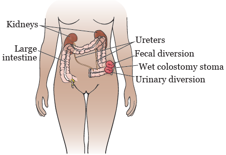 Figure 4. Wet colostomy stoma