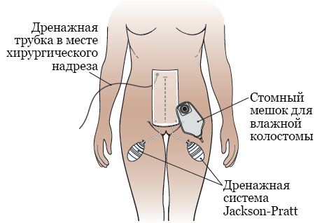 Рисунок 5. Дренажи, стомный мешок и повязки после операции
