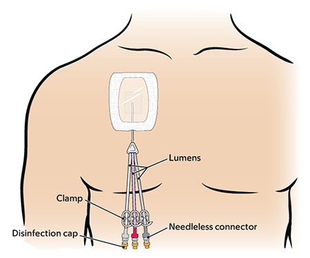 Figure 1. Tunneled catheter