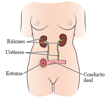 Figura 1. El sistema urinario después de la cirugía de vejiga con urostomía (conducto ileal).