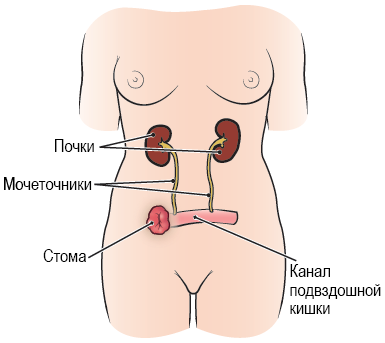Рисунок 1.  Мочевыделительная система после операции на мочевом пузыре с формированием уростомы (подвздошного канала)