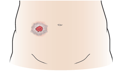 Figura 2. Acumulación de tejido alrededor del estoma