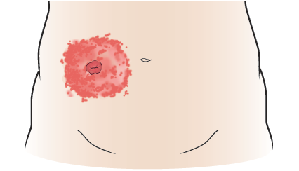 Figura 3. Reacción alérgica alrededor del estoma
