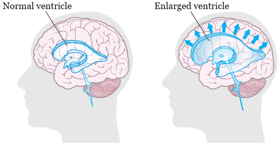Figure 1. Brain without and with hydrocephalus