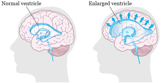 Ventriculoperitoneal Shunt Placement for Hydrocephalus in Adults - What You  Need to Know