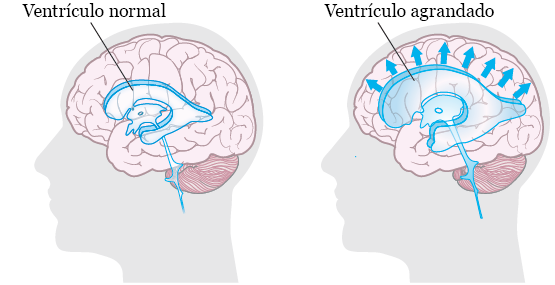 Figura 1. Cerebro sin y con hidrocefalia