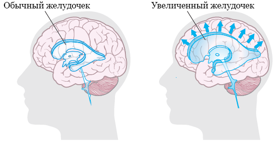 Рисунок 1.  Головной мозг без гидроцефалии и с ней