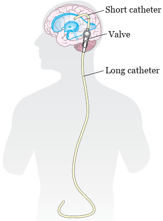 About Your Ventriculoperitoneal (VP) Shunt Surgery