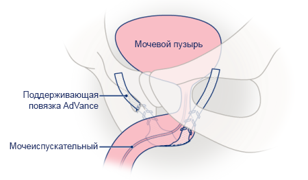 Рисунок 2. Поддерживающая повязка AdVance