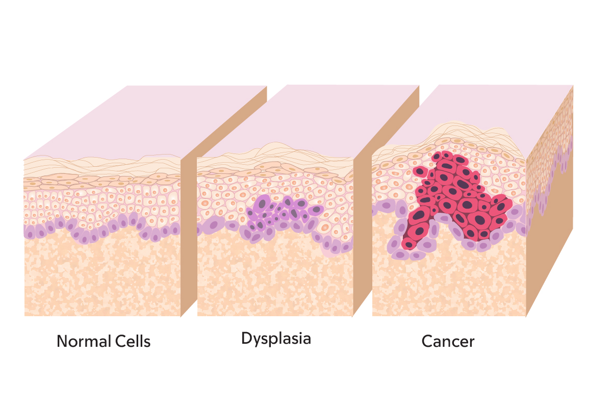 Ilustración de cáncer de ano, displasia y células normales
