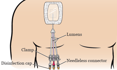 Figure 1. Tunneled catheter