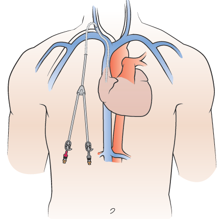 Figure 2. Catheter tunneled under your skin, into a vein