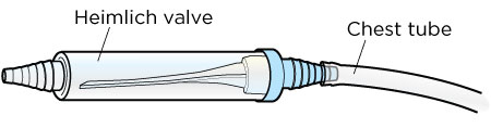 Figure 1. Chest tube and Heimlich valve