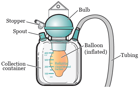 Figure 2. ReliaVac drain with balloon inflated
