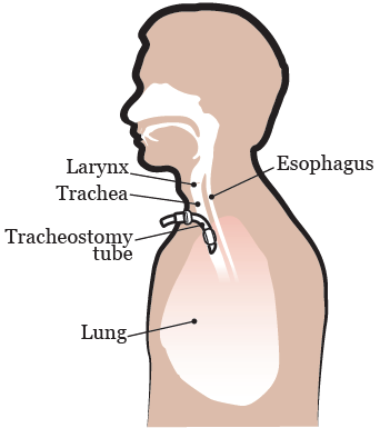 Figura 1. Colocación del tubo de traqueostomía