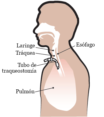 Figura 1. Colocación del tubo de traqueostomía