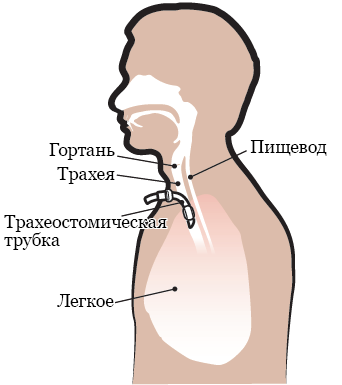 Рисунок 1.  Установка трахеостомической трубки
