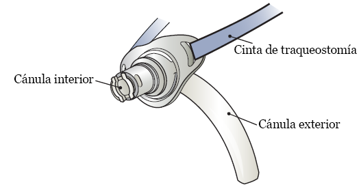 Figura 2. Cánula interna y cánula externa