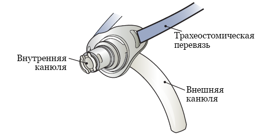 Рисунок 2.&nbsp; Внутренняя и внешняя канюли