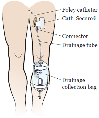 Figure 1. The parts of your Foley catheter and drainage bag