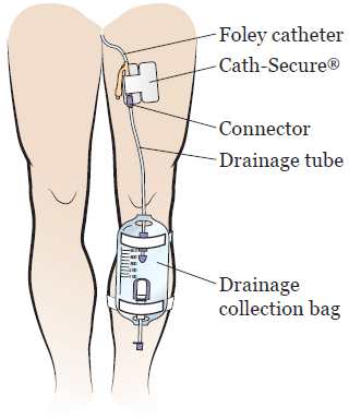 Забился катетер. Мочевой катетер. Части катетера. Foley Catheter.