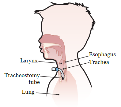 Figura 1. Colocación de tubo de traqueostomía