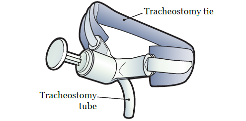 Figura 2. Tubo y cinta de sujeción de traqueostomía