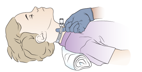 Figura 4. Colocar 1 dedo bajo la cinta de sujeción de traqueostomía
