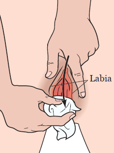 Figura 1. Limpieza de la zona entre los labios de la vagina