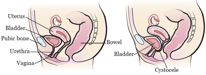 Figura 1. Anatomía femenina con (derecha) y sin (izquierda) un cistocele