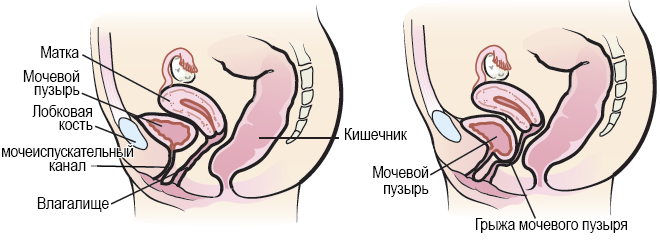 Рисунок 1.  Внутренние органы женщины с грыжей мочевого пузыря (справа) и без нее (слева)