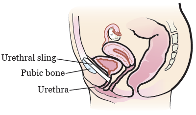 Figura 2. Anatomía femenina con un cabestrillo uretral