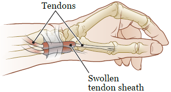 de quervain causes