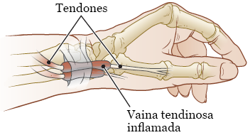 Figura 1. Muñeca con tenosinovitis de De Quervain