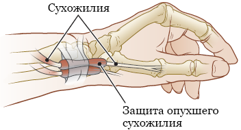 Рисунок 1.  Запястье с тендовагинитом де Кервена