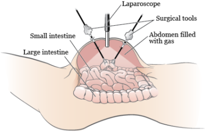 Figure 1. Your abdomen during a diagnostic laparoscopy