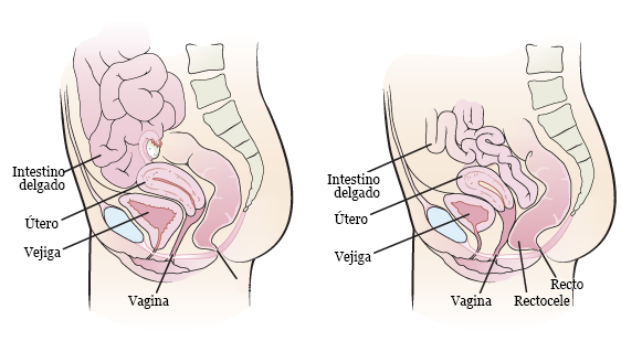 Figura 2. Anatomía femenina sin rectocele (izquierda) y con rectocele (derecha)