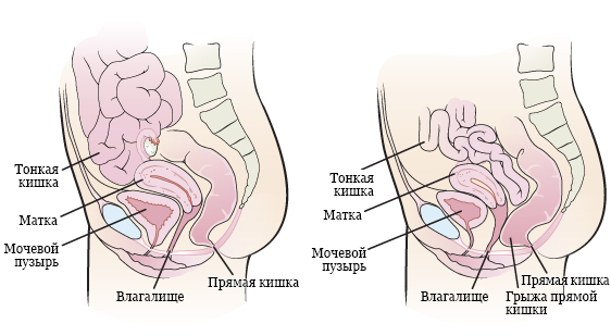 Рисунок 2.&nbsp; Внутренние органы женщины с грыжей прямой кишки (справа) и без нее (слева)