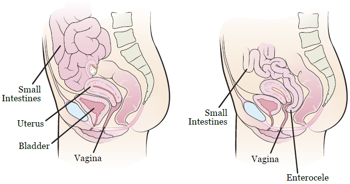 Figure 1. Female anatomy without an enterocele (left), with an enterocele (right)