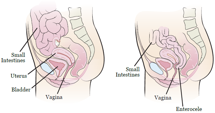 Anterior and Posterior Repair - Cherokee Women's Health