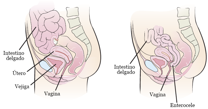 Figura 1. Anatomía femenina sin enterocele (izquierda) y con enterocele (derecha)