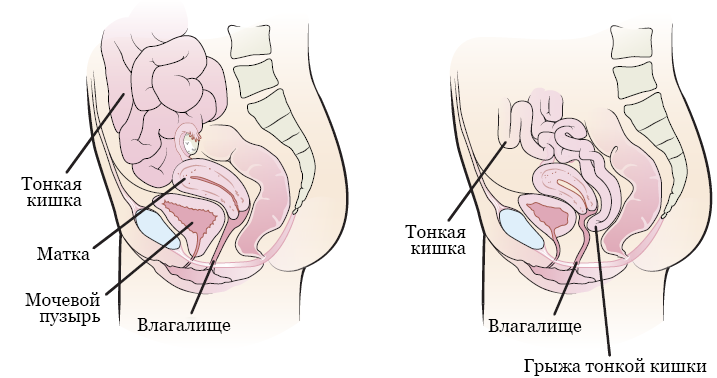 Рисунок 1.  Внутренние органы женщины с грыжей тонкой кишки (справа) и без нее (слева)