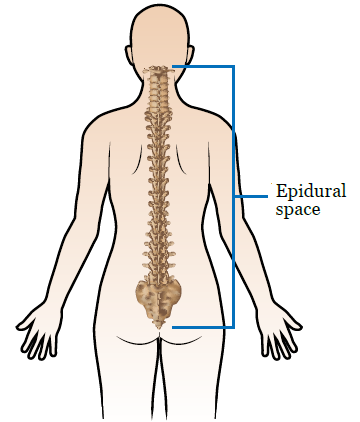 Figure 1. Your epidural space