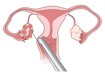 Figure 3. Egg retrieval