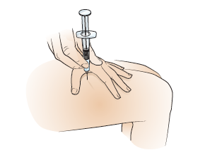 Figura&nbsp;8. Introduzca la aguja en el muslo