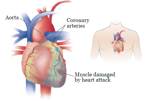Figura 1.  Músculo cardíaco dañado por la arteria coronaria obstruida