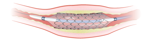 Figure 3. Balloon widening artery