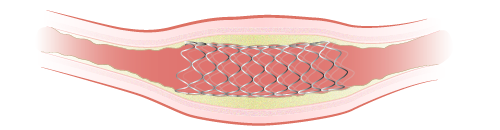 Figure 4. Stent in artery