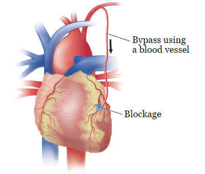 Figure 5. Coronary artery bypass
