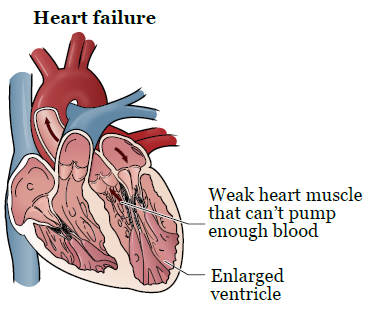 Figura 2. Corazón con insuficiencia cardíaca